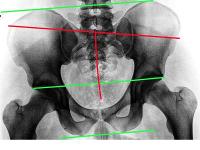 JAY Cushions: Pelvic Obliquity Management